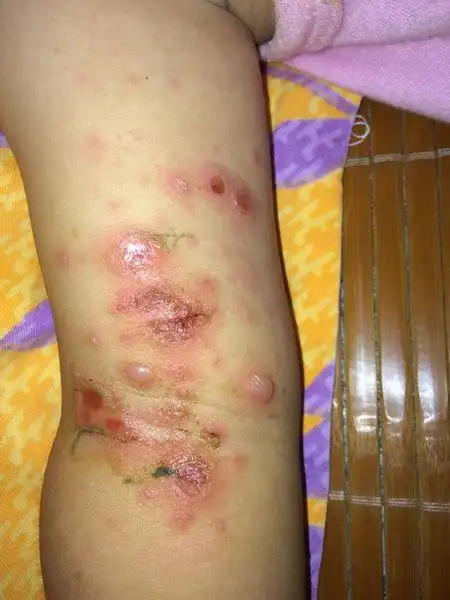 越来越严重了,宝宝手臂上先是长小红点,然后变成小水泡接着变成大水泡