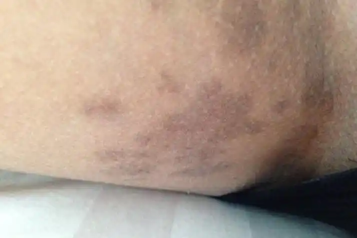 腹股沟黑褐色斑图片