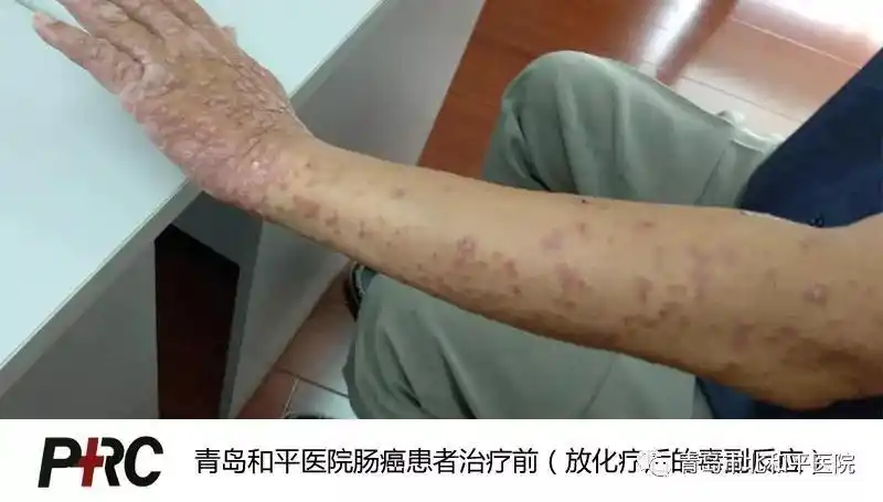 还是以近年治疗的一位周姓直肠癌患者为例:他在一七年三月突觉肛门不