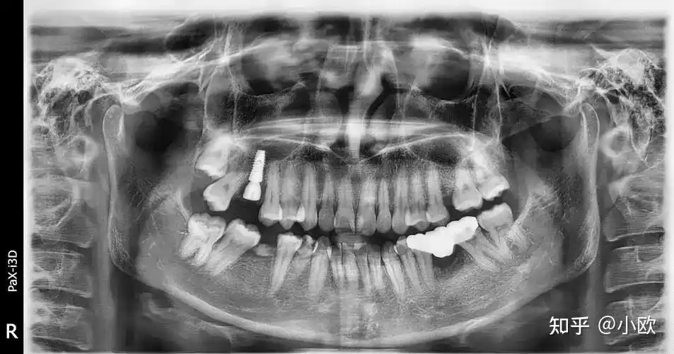 牙科常用的 x 光片主要有三种:小牙片,全景片和口腔cbct .