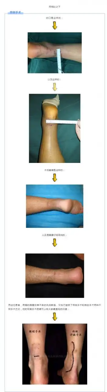 其实跟腱多是被自己搞断的