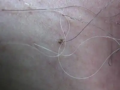 男性产生阴虱的症状特点当了解