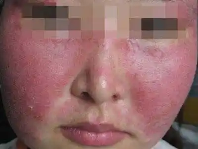 系统性红斑狼疮这是最近比较时髦的疾病,曾经的"酒渣鼻"就是玫瑰痤疮