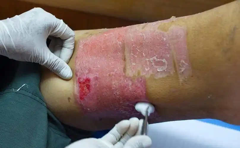 我撞见老公和情人,致他睾丸扭转,需手术切除_影响_男性_寿命