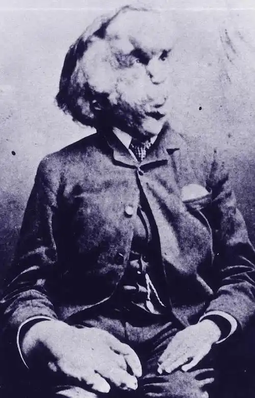 英国伦敦发现象人约瑟夫梅里克josephmerrick墓地病因至今没有定论