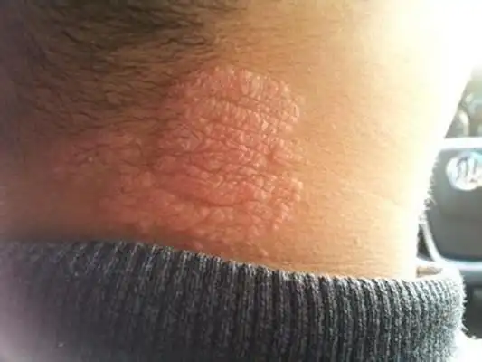 宝宝身上长癣图片 (11)