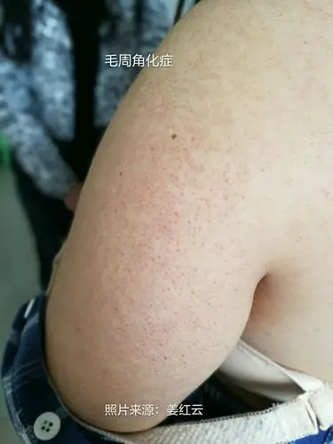毛周角化症与毛囊炎的鉴别.