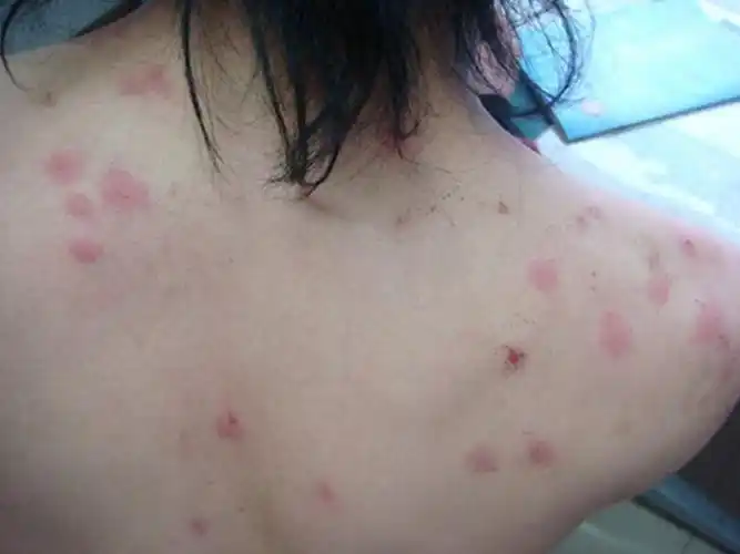 面部螨皮炎的图片