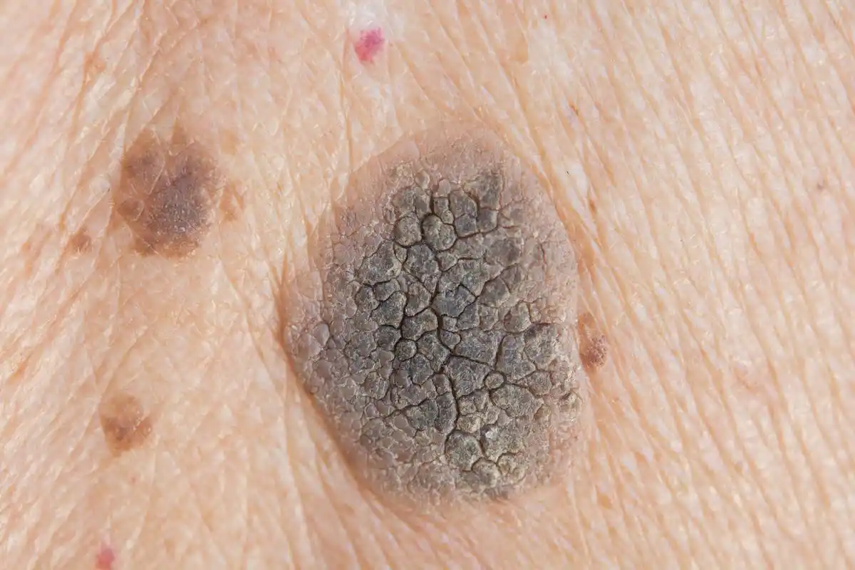 对于普通人而言,为了降低患上黑色素瘤的风险,有以下几点建议:  1.