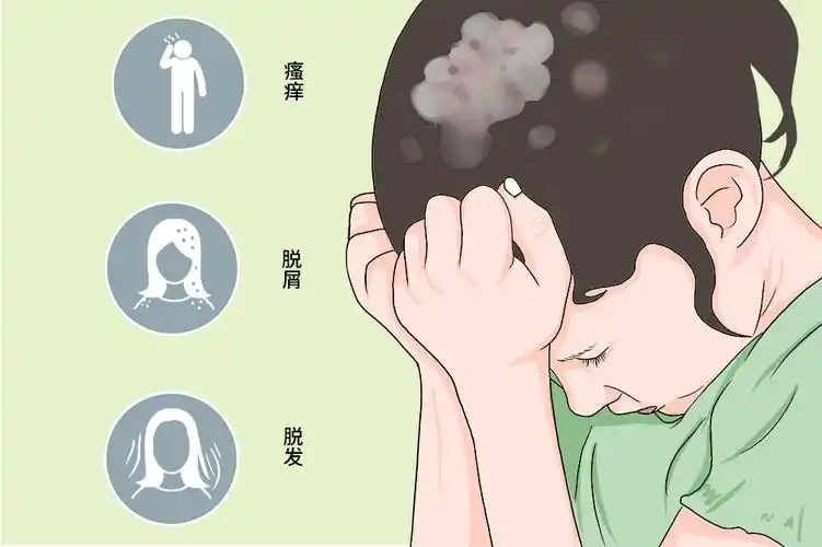 头癣是由于头部毛发真菌感染引起的传染性疾病,主要表现为脱发,头皮