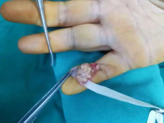 手部肿瘤-腱鞘巨细胞瘤 - 好大夫在线