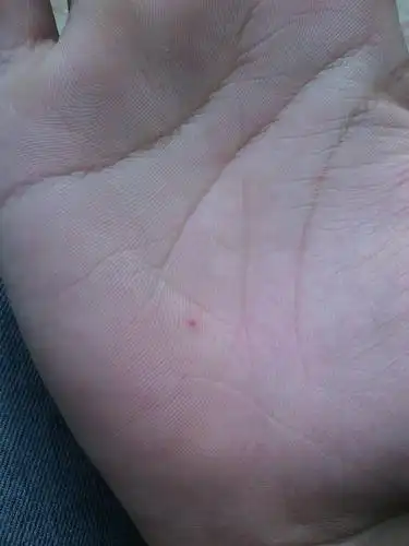 我手上长了一个红点好几年了.好不好请大师看看