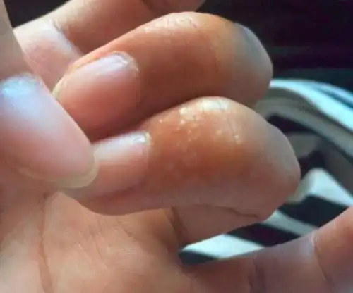 真菌性手足皮肤病之手足癣的临床表现,病因,鉴别及护理方法