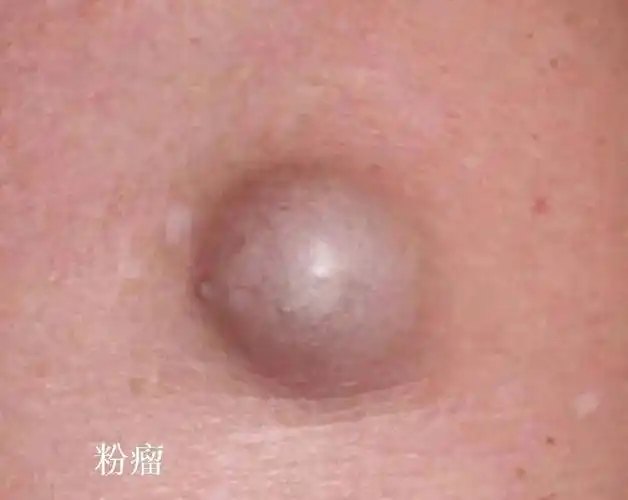 所形成的潴留性囊肿,多分布在人的头部躯干或生殖器的皮肤皮下组织内