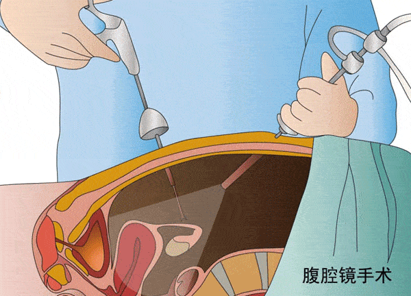 宫腹腔镜联合手术,开启您好孕梦想_宫腔镜_治疗_子宫