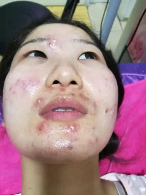 在这个炎热的夏季就是容易长痘痘.