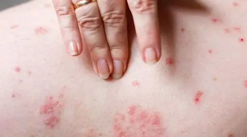 亚急性湿疹属于不干不湿的;而慢性湿疹则是有抓痕或是红斑症状,皮疹