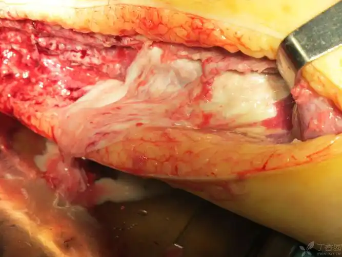 【求助】疑似坏死性筋膜炎一例