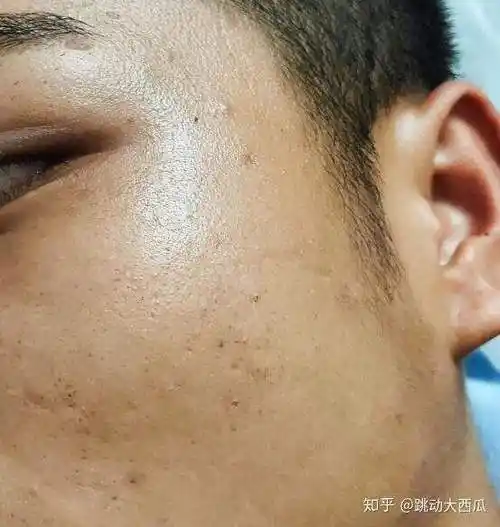 油皮毛孔粗大的男生用朗仕好还是碧欧泉好