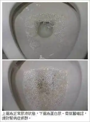 是什么原因正常成年人尿液一般呈透明或者淡黄色,尿液中很少有泡沫