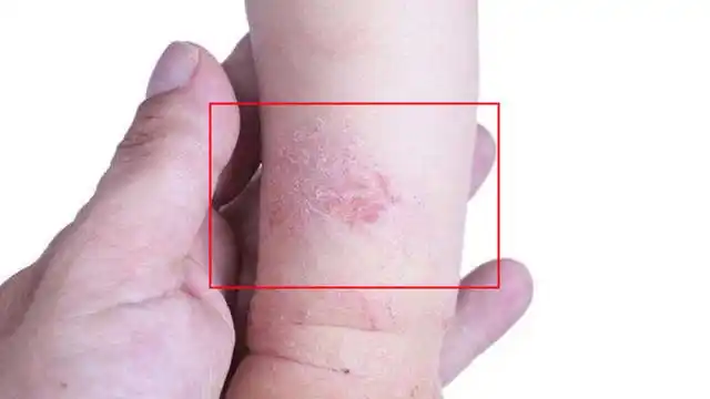 红霉素软膏,相信不少人都使用过,比如孩子红屁屁,皮肤干燥,眼睛肿了