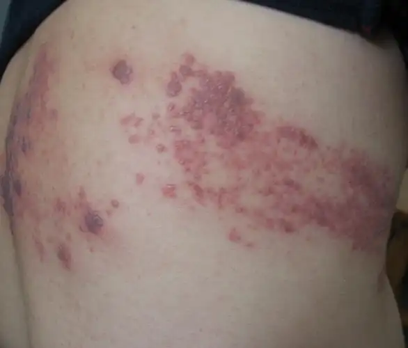 蛇盘疮初期图片_39健康网