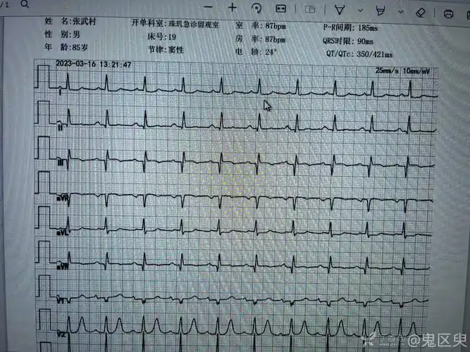 突发意识丧失的老人家心电图t波高尖
