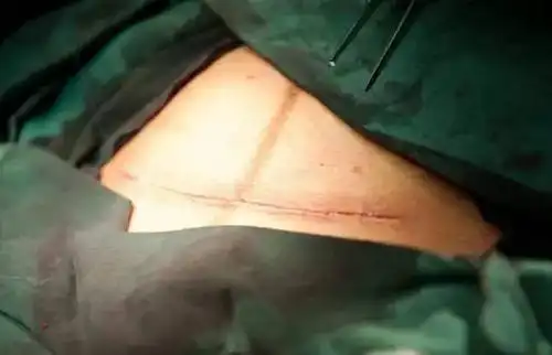 手术过程中虽然也出了不少血,但没有流个不停 现在采用的是内缝合技术