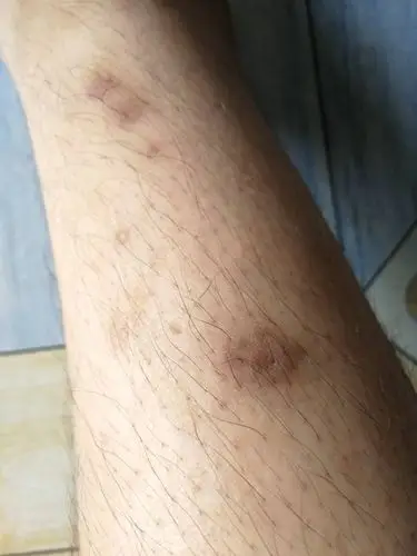 我的腿有这些伤疤已经4-5个月了.