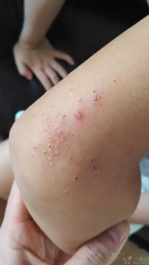 小儿肘外侧疹子,求诊断 [病例帖]