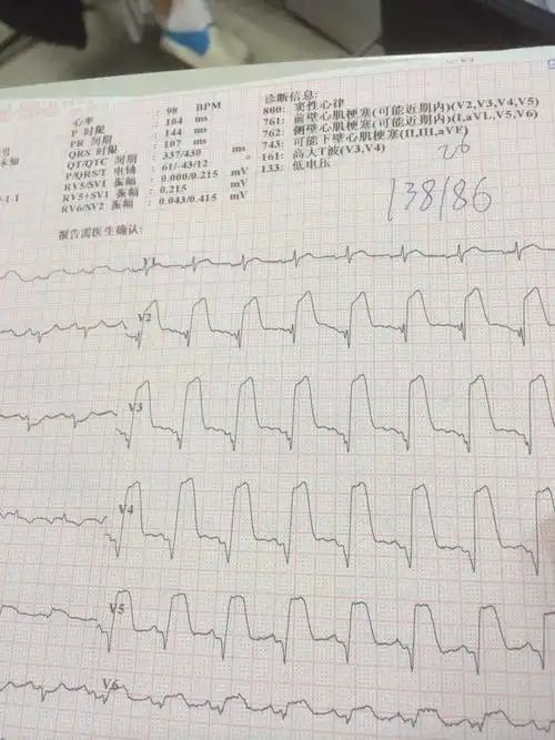有人说墓碑样心电图了…我来说一个吧…遇到的第一个墓碑样心电图stt
