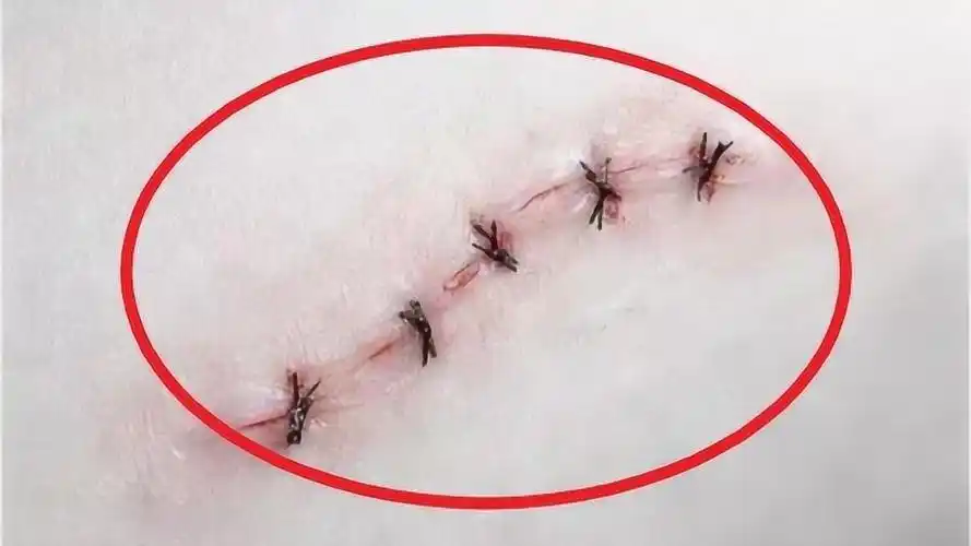 超神奇的医用胶水60秒愈合伤口不留疤国外已经开始使用