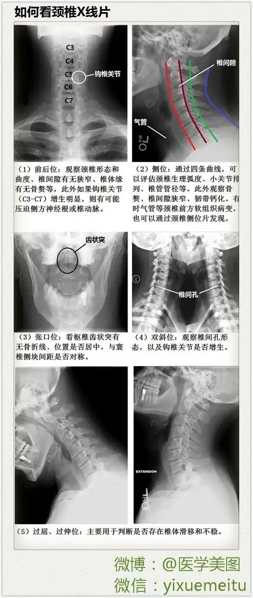 一图读懂颈椎x线片