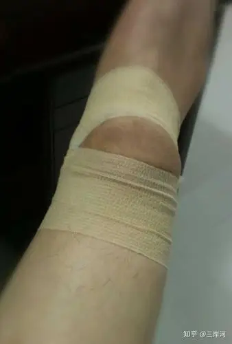 有人半月板受伤后恢复跑步的吗?