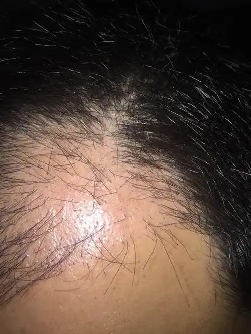 两个月掉成这个样子,毛囊移植手术还有用吗