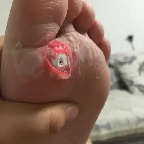 鸡眼弄了弄成这样了,用去医院挖一下还是用眼膏什么的?大概多久能好