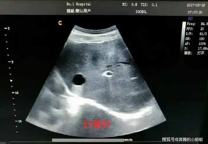 影响_肝脏_症状