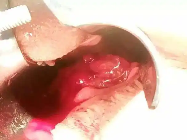 肛裂,结肠炎,消化道溃疡等有关;而中老年便血,多与内痔,缺血性肠炎,大