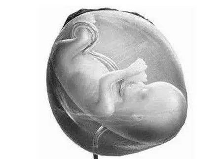 脐带绕颈一定要剖宫产吗?