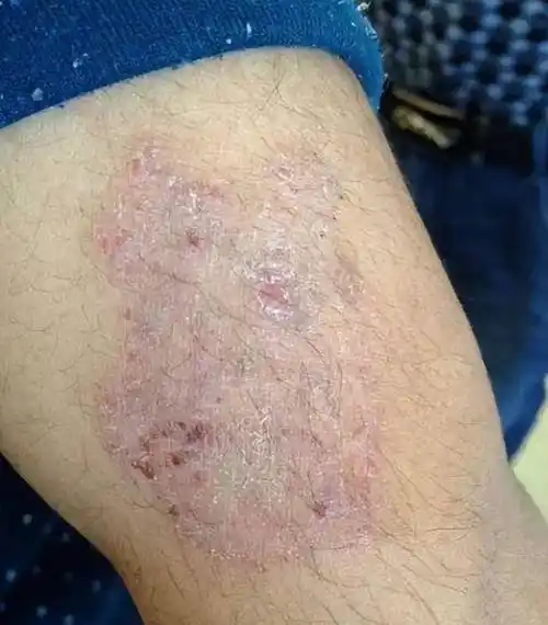 身上长这种圆形红斑,越抓越痒,这可能是体癣!_皮肤_治疗_医生