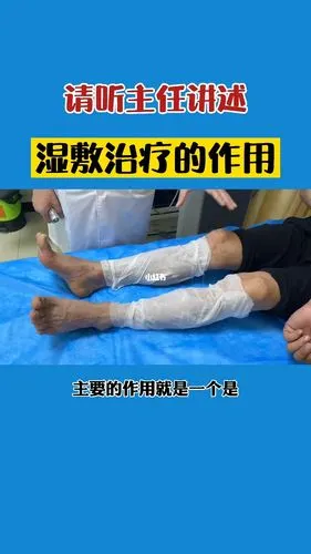 湿敷对于银屑b治疗的作用
