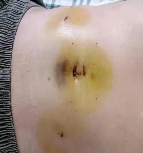 极大程度的减少了手术给患者带来的不便和痛苦↓↓↓一 阑尾粘液腺癌