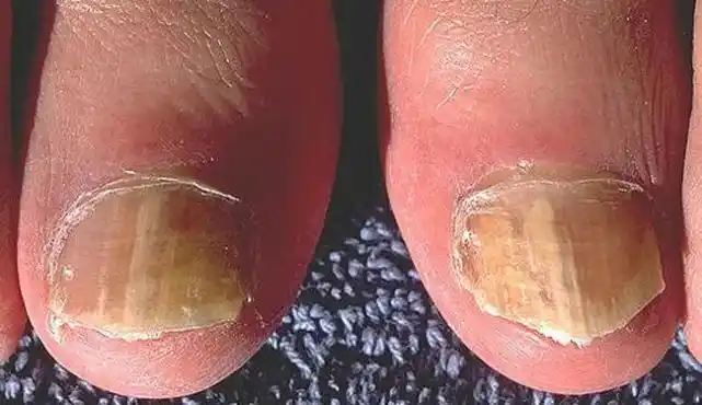 灰指甲增厚易反复怎么办专家选对方法是关键灰指甲一连锅端