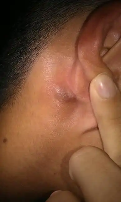 耳垂边有一块鼓包,越来越硬了,现在已经十多天了,刚开始会痛,现在不会