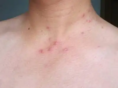 性病图片_性病症状表现图片大全_有来医生