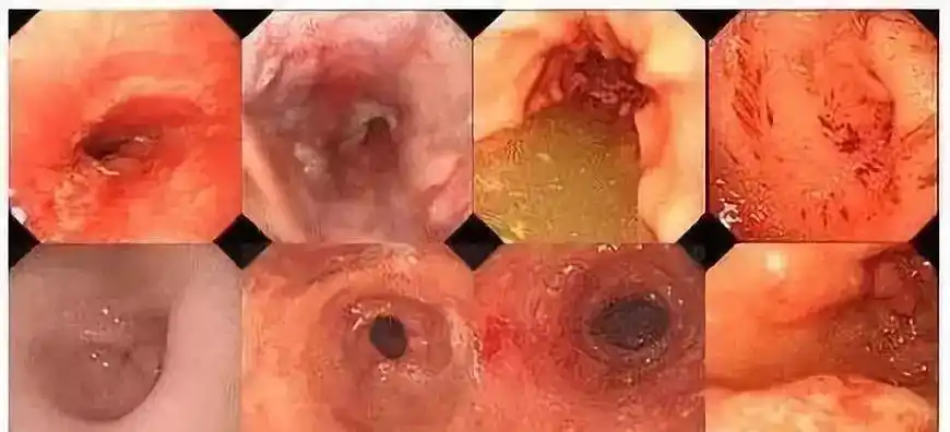 胃溃疡和胃糜烂是一回事吗胃肠科医生告诉你