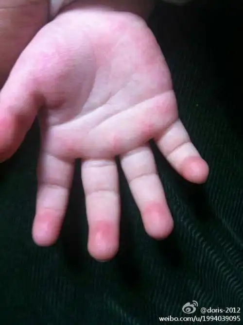 小孩手掌发红是什么原因?谢谢