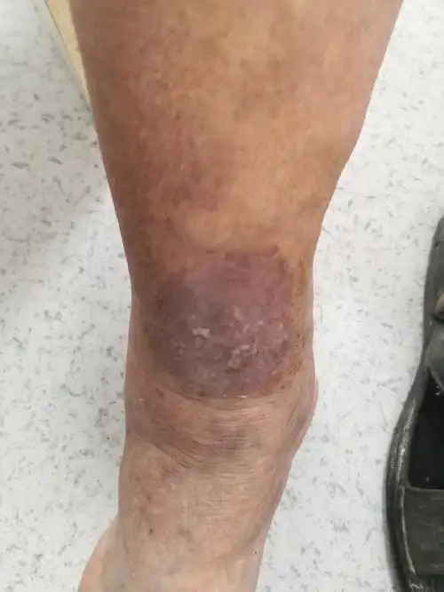 经过一段时间治疗后逐渐减轻症状.皮疹干燥脱屑.