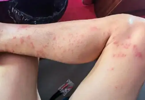 人被蚂蚁咬伤差点丢命,收下这份《毒虫咬伤急救手册》