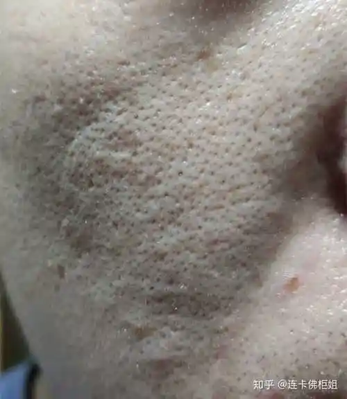 毛孔粗大黑头多的女孩到底该怎么办?